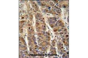 C4BPA antibody immunohistochemistry analysis in formalin fixed and paraffin embedded human hepatocarcinoma followed by peroxidase conjugation of the secondary antibody and DAB staining. (C4BPA Antikörper  (C-Term))