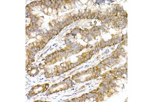 Immunohistochemistry of paraffin-embedded human colon carcinoma using RPL10A Rabbit mAb (ABIN7269992) at dilution of 1:25 (40x lens).