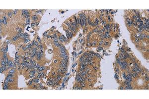 Immunohistochemistry of paraffin-embedded Human colon cancer using PRKD3 Polyclonal Antibody at dilution of 1:50 (PRKD3 Antikörper)
