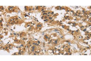 Immunohistochemistry of paraffin-embedded Human thyroid cancer using GAS7 Polyclonal Antibody at dilution of 1:50 (GAS7 Antikörper)