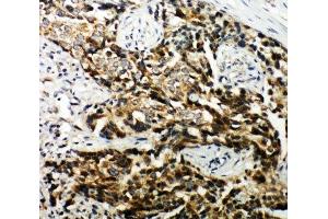 IHC-P: TSC1 antibody testing of human breast cancer tissue (TSC1 Antikörper  (C-Term))