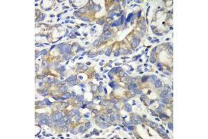 Immunohistochemistry of paraffin-embedded human gastric cancer using ABAT antibody (ABIN1876487) at dilution of 1:100 (40x lens). (ABAT Antikörper)