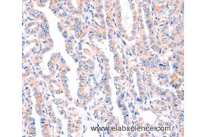 Immunohistochemistry of Human thyroid cancer using AMPD1 Polyclonal Antibody at dilution of 1:70 (AMPD1 Antikörper)
