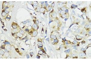 Immunohistochemistry of paraffin-embedded Human mammary cancer using Complement Factor B Polyclonal Antibody at dilution of 1:200 (40x lens). (Complement Factor B Antikörper)