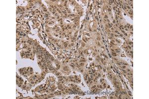 Immunohistochemistry of Human gastric cancer using CAB39 Polyclonal Antibody at dilution of 1:50 (CAB39 Antikörper)