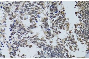 Immunohistochemistry of paraffin-embedded Human lung cancer using LKB1 Polyclonal Antibody at dilution of 1:100 (40x lens). (LKB1 Antikörper)