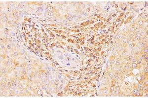 Immunohistochemistry of paraffin-embedded Human breast cancer using Il2 Polyclonal Antibody at dilution of 1:100 (IL-2 Antikörper)