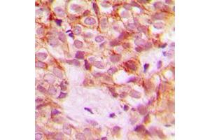 Immunohistochemical analysis of Collagen 1 alpha 2 staining in human breast cancer formalin fixed paraffin embedded tissue section. (COL1A2 Antikörper  (Center))