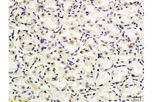 Formalin-fixed and paraffin embedded human gastric adenocarcinoma labeled with Anti-CD162 Polyclonal Antibody, Unconjugated (ABIN679298) followed by conjugation to the secondary antibody (SELPLG Antikörper  (AA 251-350))