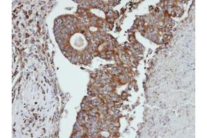 IHC-P Image Immunohistochemical analysis of paraffin-embedded human endo mitral ovarian cancer, using CTSS, antibody at 1:100 dilution. (Cathepsin S Antikörper)
