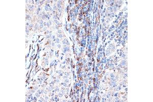 Immunohistochemistry of paraffin-embedded human esophageal cancer using DCP1A Rabbit mAb (ABIN7266678) at dilution of 1:100 (40x lens). (DCP1A Antikörper)