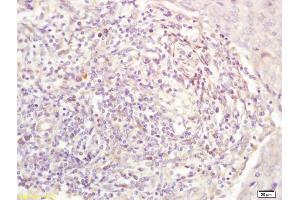Formalin-fixed and paraffin embedded human breast carcinoma labeled with Anti-STK38 Polyclonal Antibody, Unconjugated (ABIN716471) at 1:200 followed by conjugation to the secondary antibody (STK38 Antikörper  (AA 31-130))