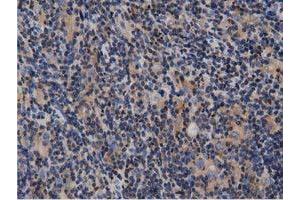 Immunohistochemical staining of paraffin-embedded Human lymphoma tissue using anti-ARHGAP25 mouse monoclonal antibody. (ARHGAP25 Antikörper)