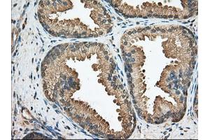 Immunohistochemical staining of paraffin-embedded Adenocarcinoma of Human ovary tissue using anti-BCL10 mouse monoclonal antibody. (BCL10 Antikörper)