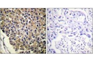 Immunohistochemistry analysis of paraffin-embedded human breast carcinoma, using IL-8R beta/CDw128 beta (Phospho-Ser347) Antibody. (CXCR2 Antikörper  (pSer347))