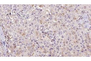ABIN6273333 at 1/100 staining Human thyroid cancer tissue by IHC-P. (TRAPPC9 Antikörper  (Internal Region))