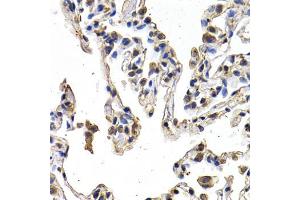 Immunohistochemistry of paraffin-embedded human lung cancer using VEGFD antibody (ABIN5970538) at dilution of 1/200 (40x lens). (VEGFD Antikörper)
