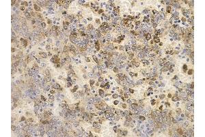 ABIN6256218 and ABIN6267659 at 1/100 staining human melanoma by IHC-P. (SMAD2 Antikörper  (pSer250))