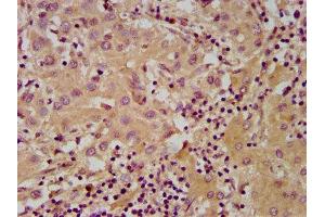 IHC image of ABIN7143530 diluted at 1:600 and staining in paraffin-embedded human liver cancer performed on a Leica BondTM system. (NUDT5 Antikörper  (AA 34-166))