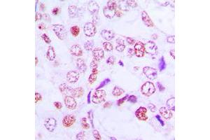 Immunohistochemical analysis of Cyclin G1 staining in human lung cancer formalin fixed paraffin embedded tissue section. (Cyclin G1 Antikörper  (Center))