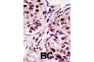 Formalin-fixed and paraffin-embedded human cancer tissue reacted with HGS polyclonal antibody  , which was peroxidase-conjugated to the secondary antibody, followed by AEC staining . (HGS Antikörper  (N-Term))