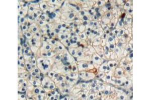 Used in DAB staining on fromalin fixed paraffin-embedded kidney cancer tissue (FAS Antikörper  (AA 21-170))