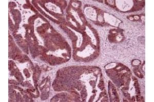 Immunohistochemistry of humen colon cancer with LARS polyclonal antibody . (LARS Antikörper)
