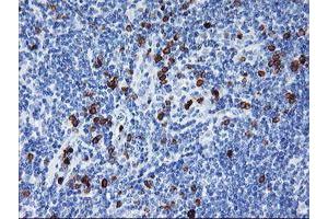 Immunohistochemical staining of paraffin-embedded Human lymphoma tissue using anti-IGJ mouse monoclonal antibody.