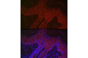Immunofluorescence analysis of human skin cancer using DKK2 Rabbit pAb (ABIN7266756) at dilution of 1:400 (40x lens). (DKK2 Antikörper  (C-Term))