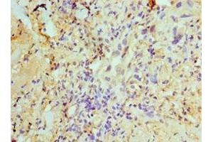Immunohistochemistry of paraffin-embedded human lung cancer using ABIN7170632 at dilution of 1:100 (U2AF1 Antikörper  (AA 1-240))