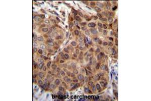 SNX24 Antibody immunohistochemistry analysis in formalin fixed and paraffin embedded human breast carcinoma followed by peroxidase conjugation of the secondary antibody and DAB staining. (SNX24 Antikörper  (N-Term))