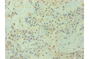 Immunohistochemistry of paraffin-embedded human breast cancer using ABIN7154586 at dilution of 1:100 (DIRAS3 Antikörper  (AA 1-229))