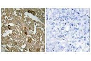 Immunohistochemistry analysis of paraffin-embedded human breast carcinoma tissue, using BTBD6 antibody. (BTBD6 Antikörper)