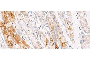 Immunohistochemistry of paraffin-embedded Human gastric cancer tissue using NDUFB7 Polyclonal Antibody at dilution of 1:35(x200) (NDUFB7 Antikörper)