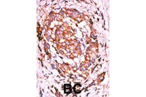 Formalin-fixed and paraffin-embedded human breast cancer tissue reacted with ERBB2 (phospho Y1248) polyclonal antibody  which was peroxidase-conjugated to the secondary antibody followed by AEC staining. (ErbB2/Her2 Antikörper  (pTyr1248))