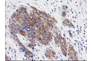Immunohistochemical staining of paraffin-embedded Adenocarcinoma of Human breast tissue using anti-EIF2B3 mouse monoclonal antibody. (EIF2B3 Antikörper)