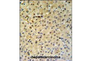 PSME1 Antibody IHC analysis in formalin fixed and paraffin embedded hepatocarcinoma followed by peroxidase conjugation of the secondary antibody and DAB staining. (PSME1 Antikörper  (C-Term))