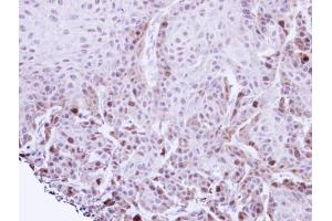 IHC-P Image Immunohistochemical analysis of paraffin-embedded Cal27 xenograft, using TACC2, antibody at 1:100 dilution.