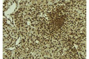 ABIN6278768 at 1/100 staining Human breast cancer tissue by IHC-P. (KAT6B Antikörper  (C-Term))