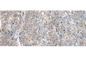 Immunohistochemistry of paraffin-embedded Human liver cancer tissue using CLTCL1 Polyclonal Antibody at dilution of 1:60(x200) (CLTCL1 Antikörper)