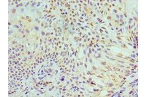 Immunohistochemistry of paraffin-embedded human breast cancer using ABIN7150341 at dilution of 1:100 (MCM7 Antikörper  (AA 360-719))