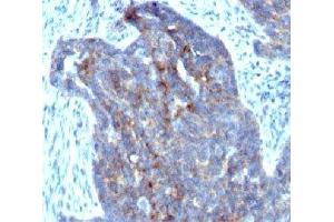 Formalin-fixed, paraffin-embedded human ovarian carcinoma stained with RBP1 (RBP/872) (RBP1 Antikörper)