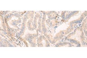 Immunohistochemistry of paraffin-embedded Human thyroid cancer tissue using SEPT10 Polyclonal Antibody at dilution of 1:25(x200) (Septin 10 Antikörper)