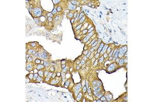Immunohistochemistry of paraffin-embedded human liver cancer using SLC22/OCT3 Rabbit mAb (ABIN7269107) at dilution of 1:100 (40x lens). (SLC22A3 Antikörper)