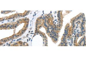 Immunohistochemistry of paraffin-embedded Human thyroid cancer using VAMP2 Polyclonal Antibody at dilution of 1/40 (VAMP2 Antikörper)