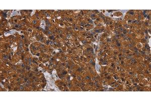 Immunohistochemistry of paraffin-embedded Human breast cancer tissue using HYAL2 Polyclonal Antibody at dilution 1:60 (HYAL2 Antikörper)