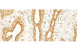 Immunohistochemistry of paraffin-embedded Human breast cancer tissue using ZNF471 Polyclonal Antibody at dilution of 1:50(x200) (ZNF471 Antikörper)