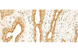 Immunohistochemistry of paraffin-embedded Human breast cancer tissue using ZNF471 Polyclonal Antibody at dilution of 1:50(x200)
