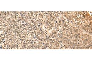 Immunohistochemistry of paraffin-embedded Human liver cancer tissue using BRF2 Polyclonal Antibody at dilution of 1:40(x200) (BRF2 Antikörper)