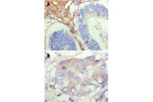 Immunohistochemical analysis of paraffin-embedded human colon cancer (A) and breast cancer (B) showing cytoplasmic localization with DAB staining using FBLN5 monoclonal antibody, clone 1G6A4 . (Fibulin 5 Antikörper)